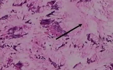 Giun lươn - "thủ phạm thầm lặng" núp bóng ung thư dạ dày