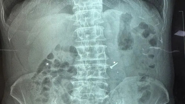 Nuốt đinh vào bụng khi đang sửa chữa trần nhà