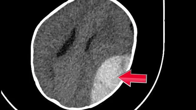 Trẻ 8 tháng tuổi phải phẫu thuật sọ não do ngã xe tròn