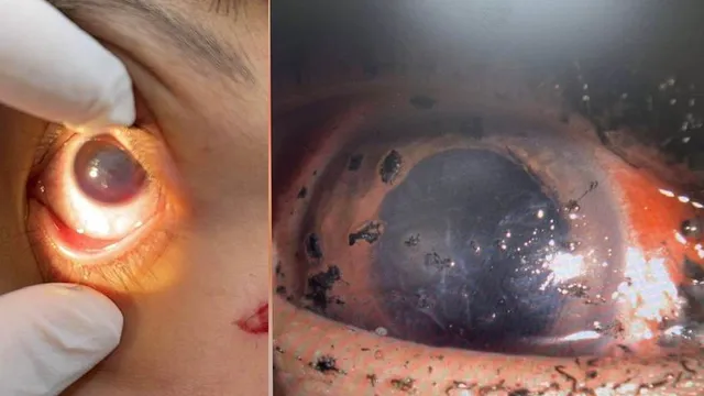 Nhiều ca chấn thương mắt do pháo nổ dịp Tết