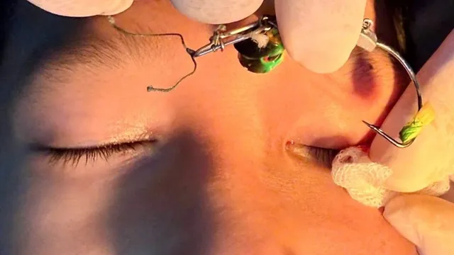 Cảnh báo chấn thương mắt ở trẻ do móc câu cá