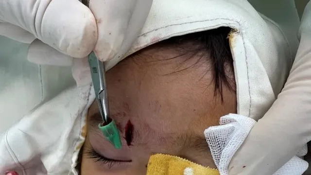 Cảnh báo nguy cơ nhiễm trùng do bỏ sót dị vật sau chấn thương ở trẻ