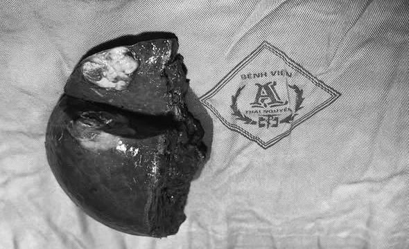 Cắt khối u gan lớn bằng kỹ thuật hiện đại, bệnh nhân phục hồi sau 1 tuần