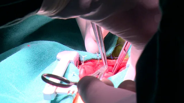 Đừng chủ quan sau sàng lọc sơ sinh: Phát hiện muộn ca tim bẩm sinh nặng