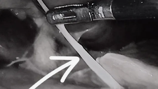 Áp xe ruột thừa do xương cá đâm thủng