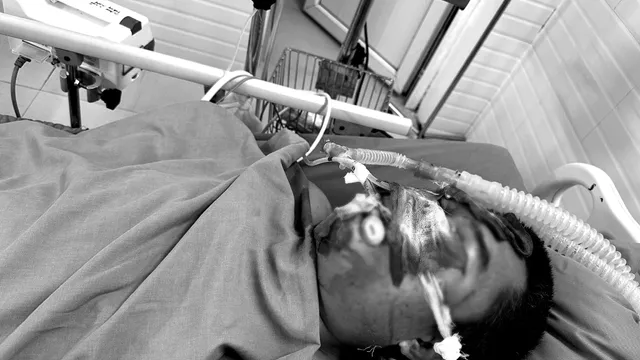 Cứu sống ngoạn mục bệnh nhân động kinh ngừng tuần hoàn do bỏng nặng