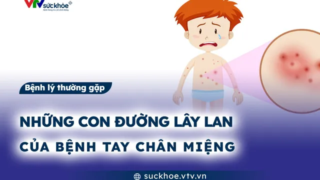 Những con đường lây lan của bệnh tay chân miệng