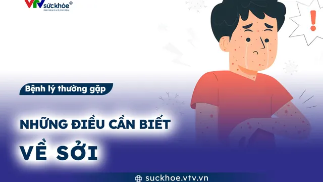 Những điều cần biết về sởi