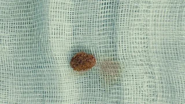 Cảnh giác sỏi niệu quản ở trẻ