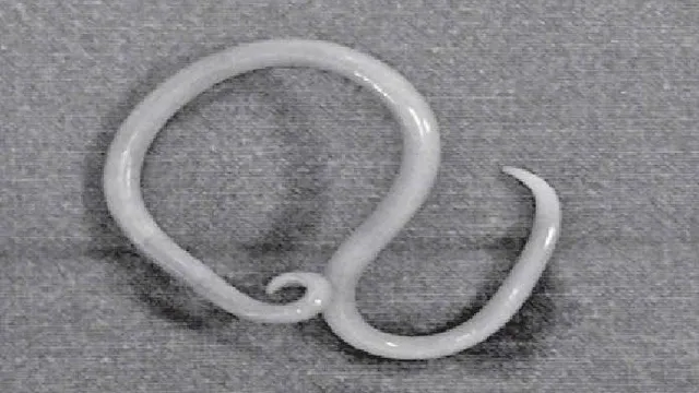 Thiếu niên bị thủng ruột do giun đũa