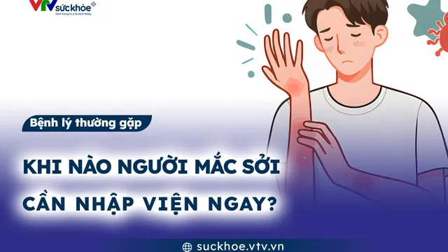 Khi nào người mắc sởi cần nhập viện ngay?