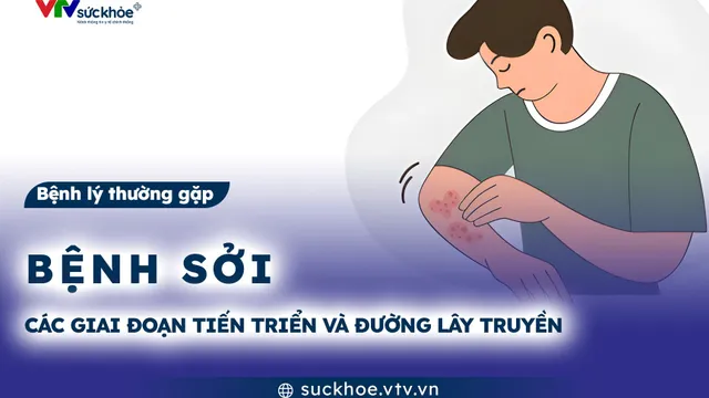 Bệnh sởi: Các giai đoạn tiến triển và đường lây truyền