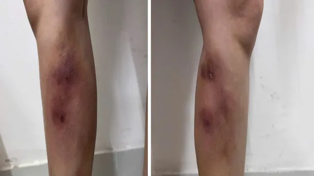 Cảnh báo biến chứng nguy hiểm khi tiêm filler làm thẳng chân tại nhà