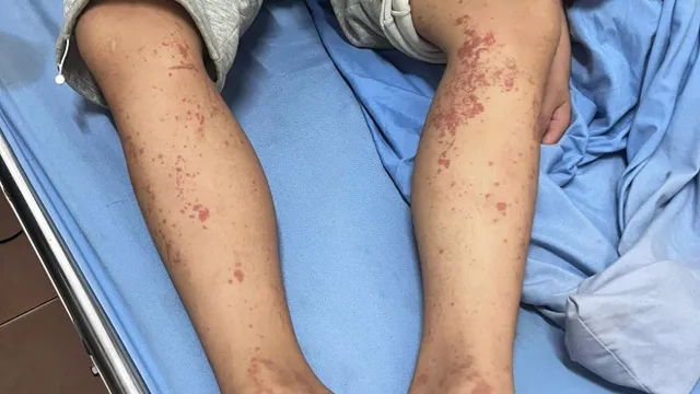 Ghi nhận ca viêm mao mạch dị ứng ở trẻ