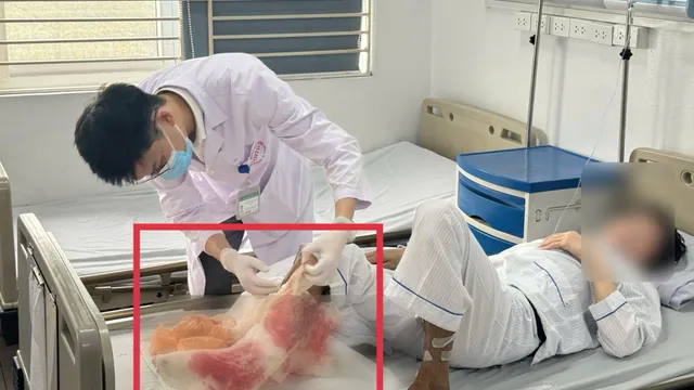 Suýt mất chân vì đắp lá chữa bỏng