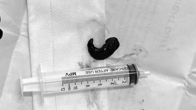 Uống nước suối, bị dị vật sống ký sinh 3 tháng trong khí quản 