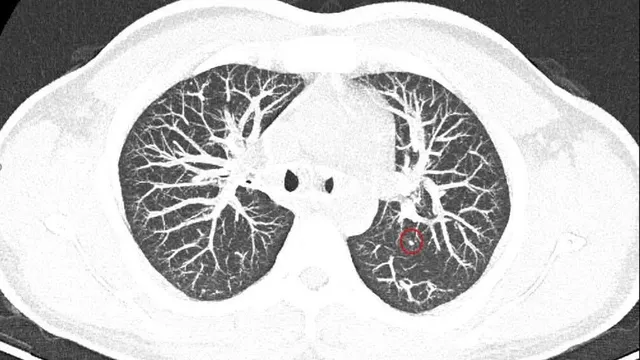 7 năm sau mổ ung thư tuyến giáp, phát hiện nghi di căn phổi
