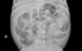 Cấp cứu thành công ca tắc ruột ở bệnh nhi 8 tháng tuổi