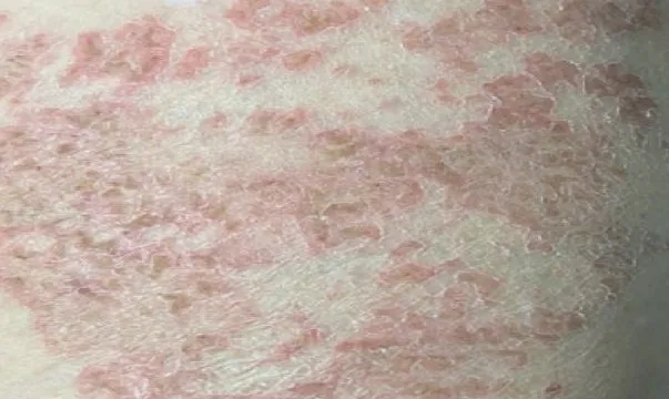 Nguyên nhân gây ngứa kéo dài 2 năm, trên da xuất hiện các vệt dài