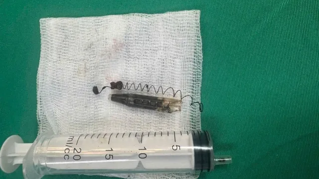 Lấy dị vật bút bi tồn tại... 13 năm trong vùng thái dương