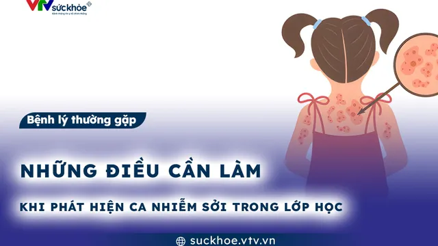 Những điều cần làm khi phát hiện ca nhiễm sởi trong lớp học