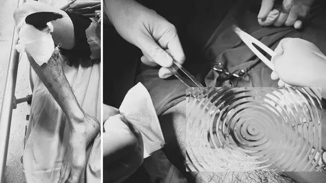 Tai nạn từ máy mài: Cảnh báo từ một ca chấn thương nặng