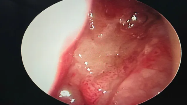 Ù tai kéo dài có thể cảnh báo ung thư vòm họng