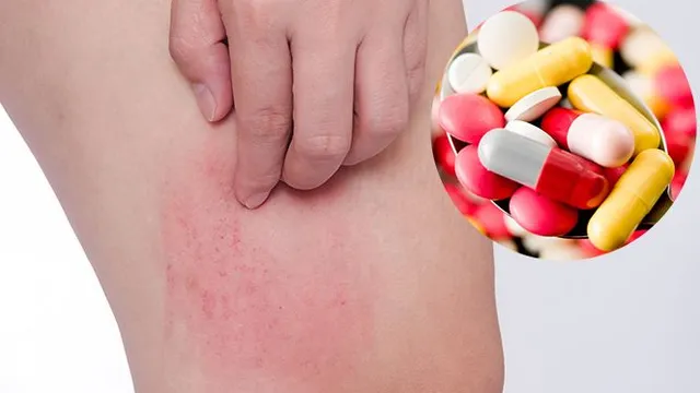 Dị ứng thời tiết mùa xuân: Dùng thuốc thế nào cho đúng?