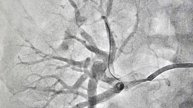 Đau bụng tưởng viêm ruột thừa, phát hiện tắc động mạch thận hiếm gặp