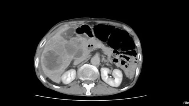 Cứu sống bệnh nhân vỡ ung thư gan nhờ can thiệp nội mạch