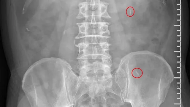 Phát hiện nhiều ký sinh trùng trong cơ thể người bệnh thích ăn gỏi cá