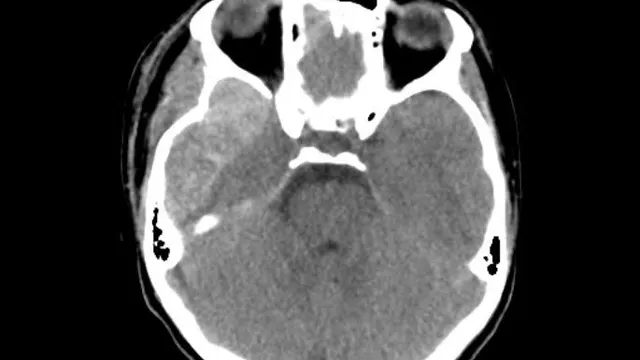 Cấp cứu tối khẩn: Cứu sống bệnh nhi 14 tuổi bị máu tụ ngoài màng cứng