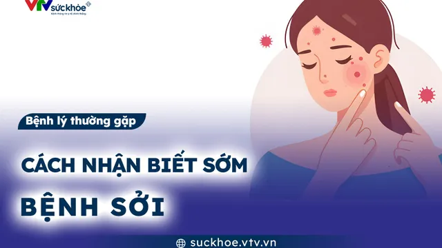 Cách nhận biết sớm bệnh sởi