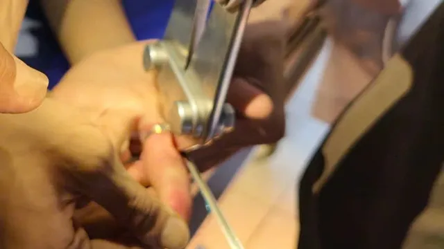 Cẩn trọng: Tai nạn đeo nhẫn gây chèn ép ngón tay ở trẻ