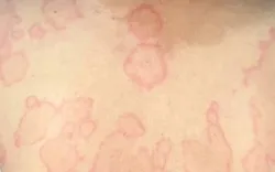 Cảnh báo mày đay mạn tính kèm phù mạch nguy hiểm