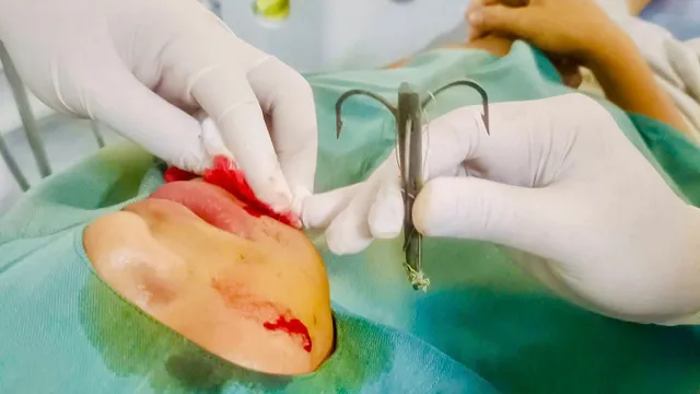 Lưỡi câu móc vào mặt bé trai khi đi câu cá