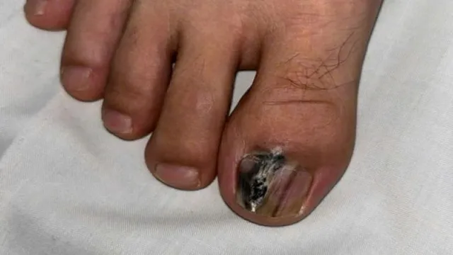 Vệt đen dưới móng có thể là dấu hiệu ung thư nguy hiểm