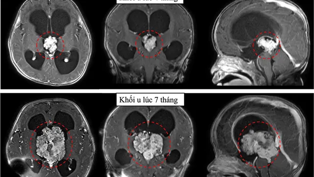 Cứu bé 7 tháng tuổi có khối u não lớn