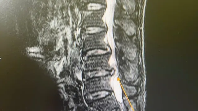 Cảnh báo biến chứng nguy hiểm từ thoát vị đĩa đệm, hẹp ống sống