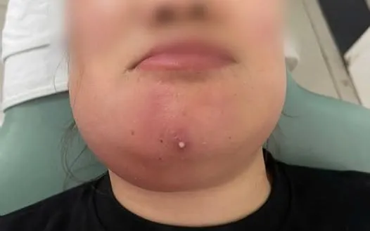 Nặn mụn sai cách, nguy cơ viêm tấy vùng mặt