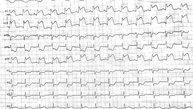 Cứu sống bệnh nhân nhồi máu cơ tim nguy kịch