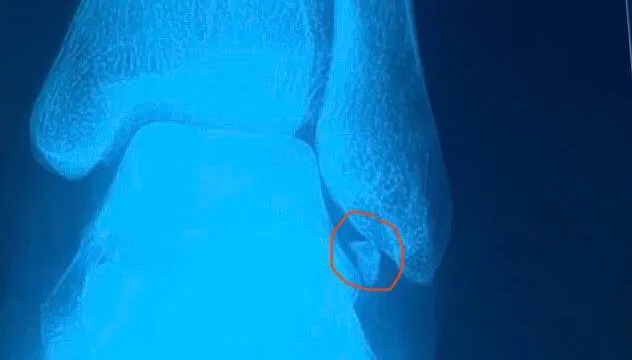 Lấy mảnh xương kẹt trong khớp cổ chân bằng nội soi