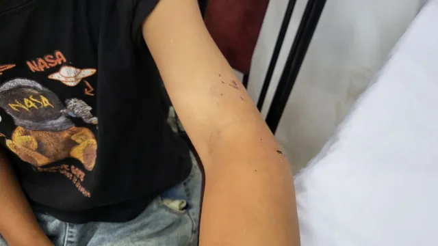 Liên tiếp chó nghi dại tấn công người dân, cảnh báo nguy cơ bệnh dại