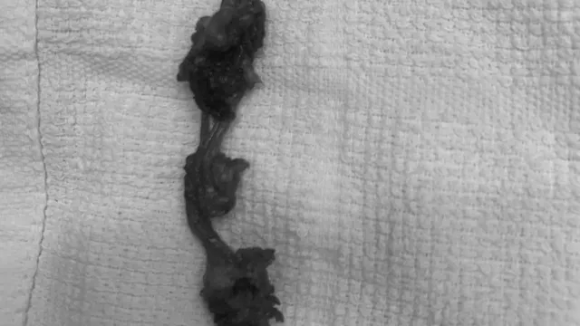 Phát hiện ca nang niệu rốn hiếm gặp