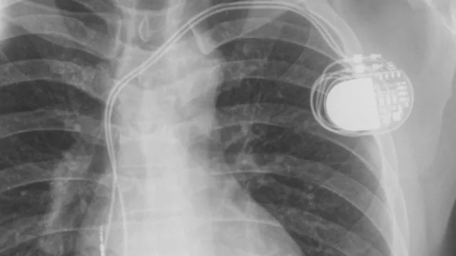 Đặt máy tạo nhịp tim vĩnh viễn thành công cho bệnh nhân chạy thận