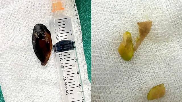 Cảnh báo nguy hiểm dị vật đường thở