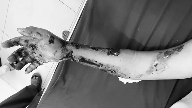 Cảnh báo nguy cơ khi xử trí bỏng muộn