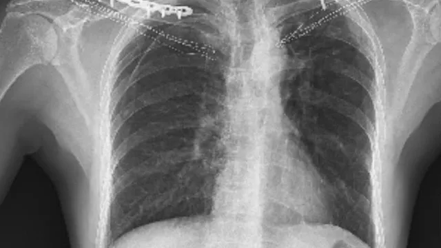 Hy hữu: Ca gãy cùng lúc hai xương đòn sau tai nạn giao thông