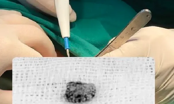 Đi khám vì sưng đau vùng hàm mặt, phát hiện sỏi kích thước lớn