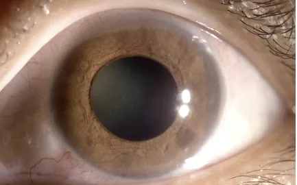 Cẩn trọng: Thoái hóa võng mạc do cận thị nặng